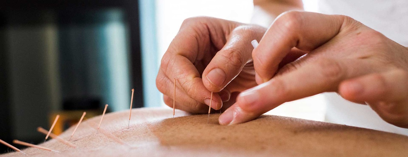 Image of acupuncture